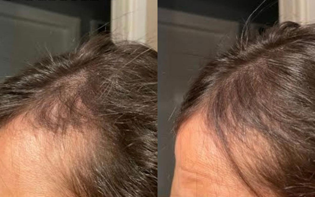 Adriana utilizza da circa 6 mesi l'integratore per capelli Nutricum Tricostrong. Qui il prima e dopo del suo trattamento.