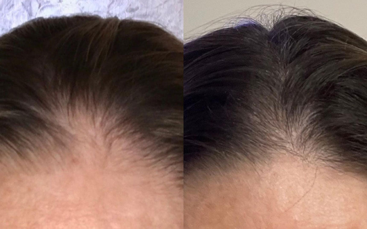 Antonella utilizza da circa 4 mesi i prodotti per capelli Stanartis. L'uso continuativo l'ha certo premiata: qui il suo prima e dopo.
