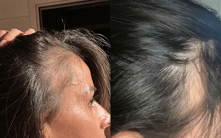 Carmela prima dopo l'uso compresse e kit anticaduta capelli