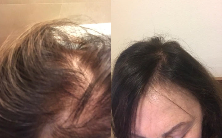 Prima e dopo 3 mesi e mezzo di uso continuo degli integratori anticaduta capelli Stanartis. Che risultato Eugenia!