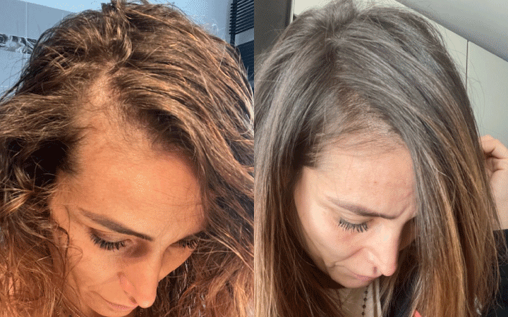 Dopo un solo mese di cura con le compresse anticaduta di Stanartis, Maria ha già i capelli visibilmente più folti