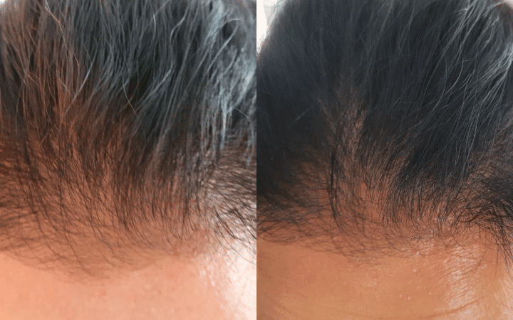 Dei capelli visibilmente più folti dopo 2 mesi di trattamento con l'integratore anticaduta capelli Tricostrong di Stanartis!