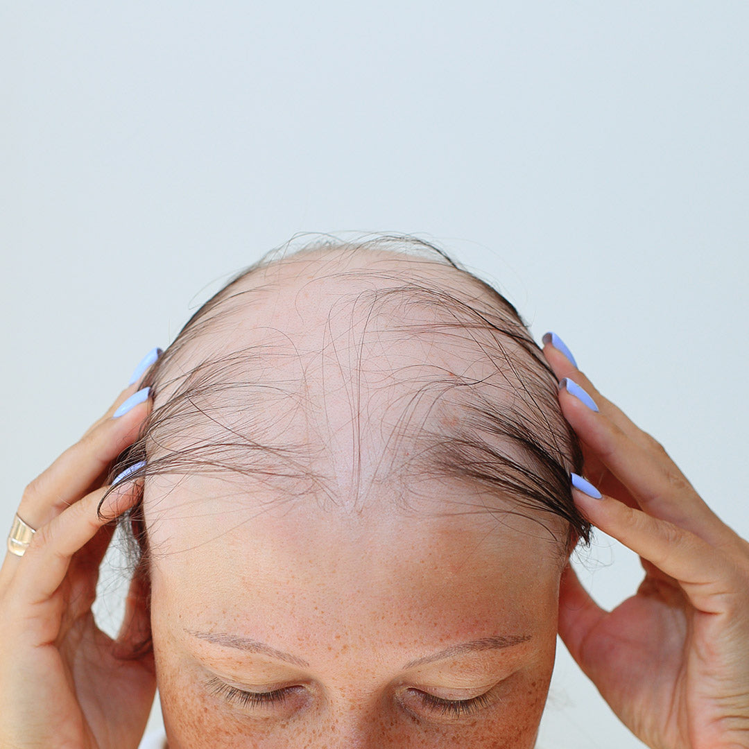 cura per alopecia androgenetica femminile