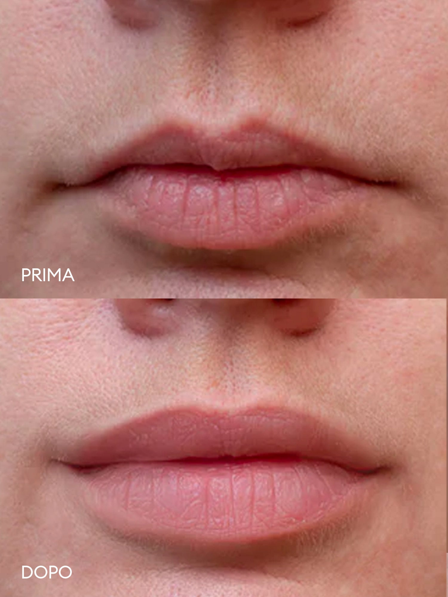 Prima e Dopo Lip Lasting - Stanartis