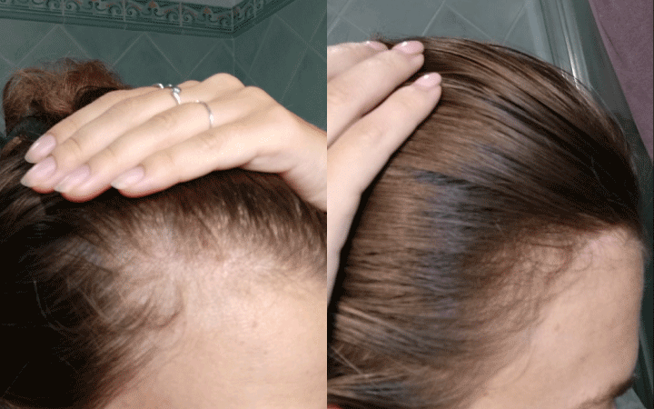 Prima e dopo un mese di trattamento con compresse anticaduta capelli, Gemma osserva i risultati!