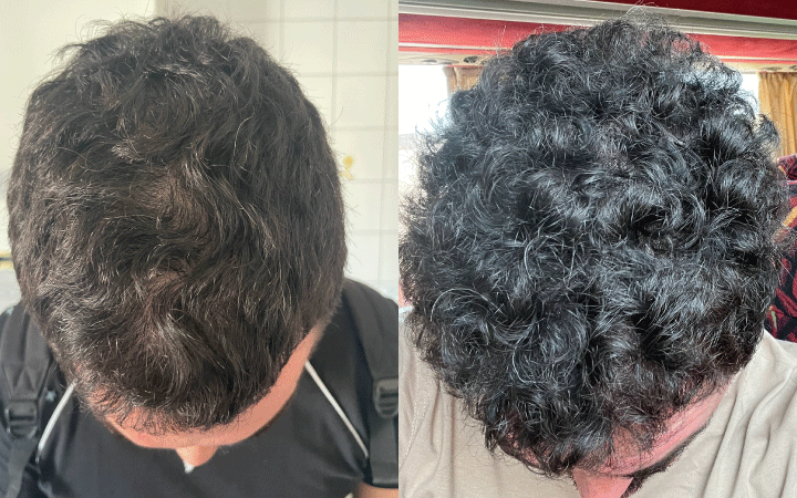Prima dopo Gianluca dopo un mese di trattamento con gli integratori per capelli Nutricum Tricostrong.