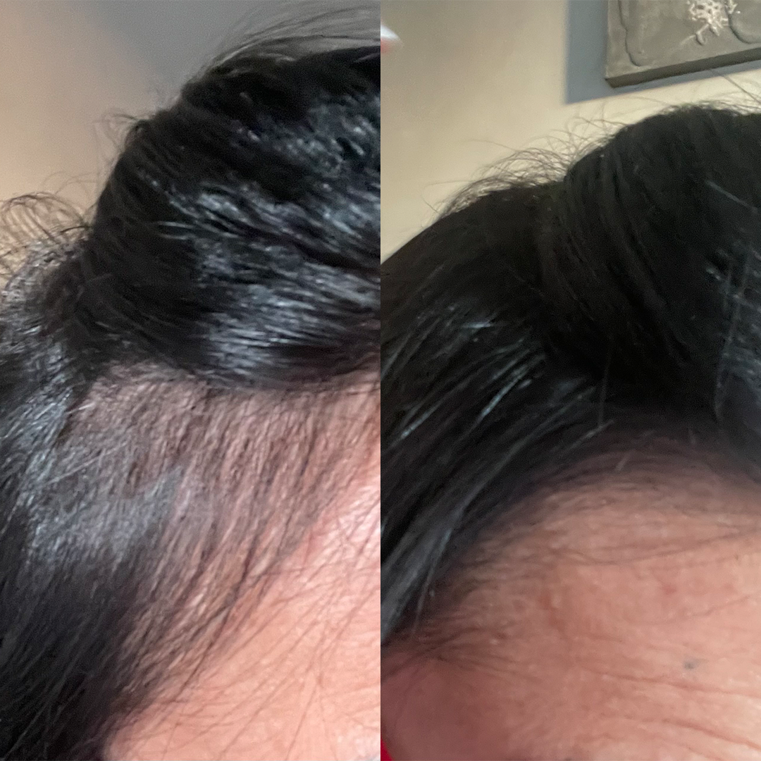 Ricrescita capelli dopo trattamento anticaduta