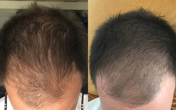 Risultati dopo 4 mesi di Tricostrong®
