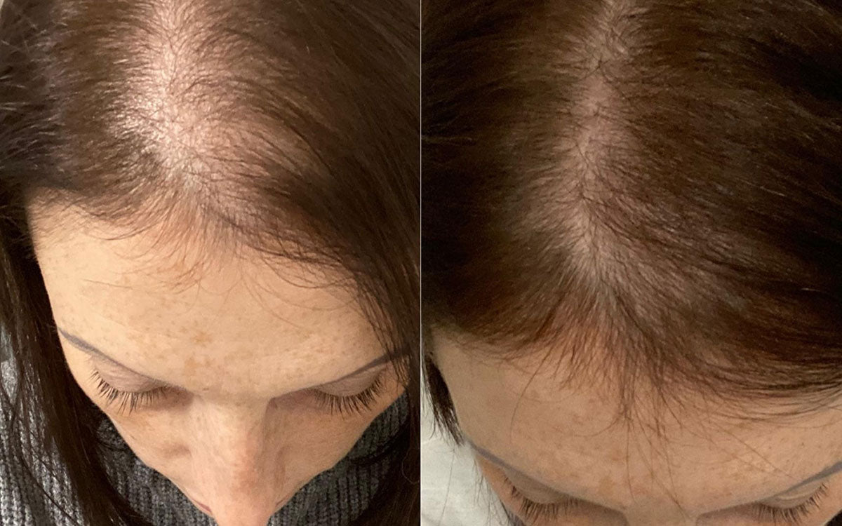 Rosaria utilizza i prodotti per capelli Stanartis da circa 4 mesi. L'infoltimento e la crescita di nuovi capelli è già evidente.
