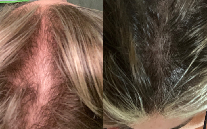 Dopo 4 mesi di utilizzo del kit anticaduta capelli con dermastamp, i capelli sono notevolmente più folti!