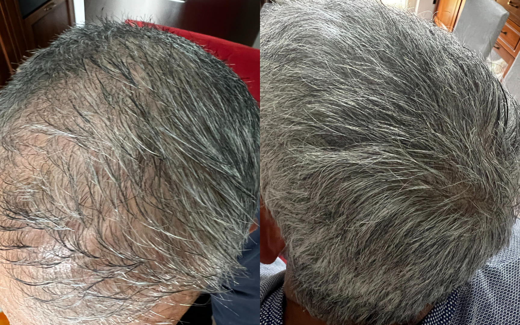 Risultati dopo 6 mesi di Tricostrong®, Lozione e Shampo