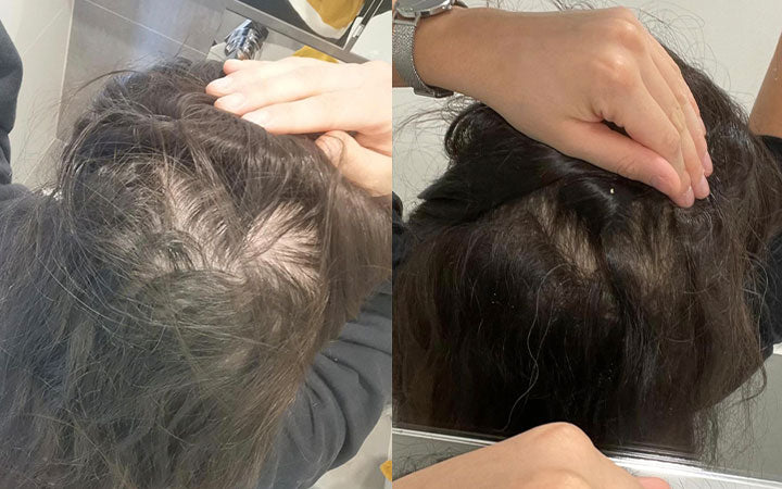 Alessandra: prima dopo utilizzo integratori anticaduta capelli Stanartis
