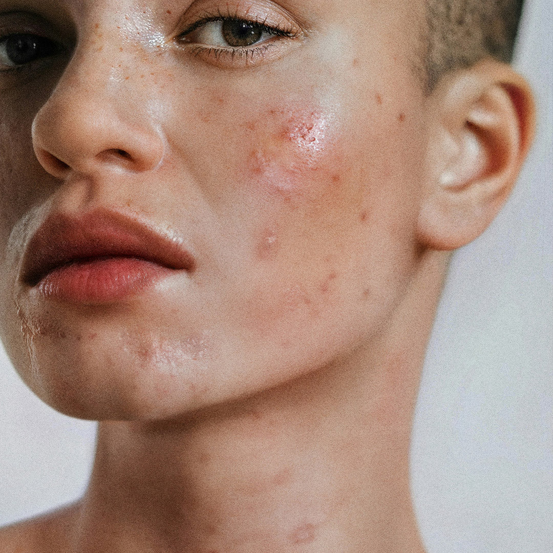 Trattamento per acne e imperfezioni