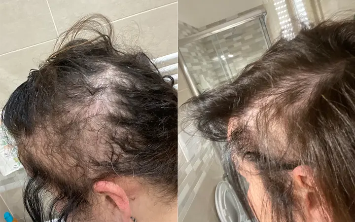 Guarda il risultato su Giovanna dopo un mese e mezzo di trattamento con gli integratori per capelli Nutricum!