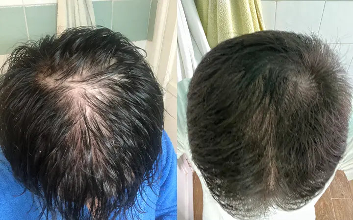 Prima e Dopo 4 mesi di trattamento con Nutricum Tricostrong®